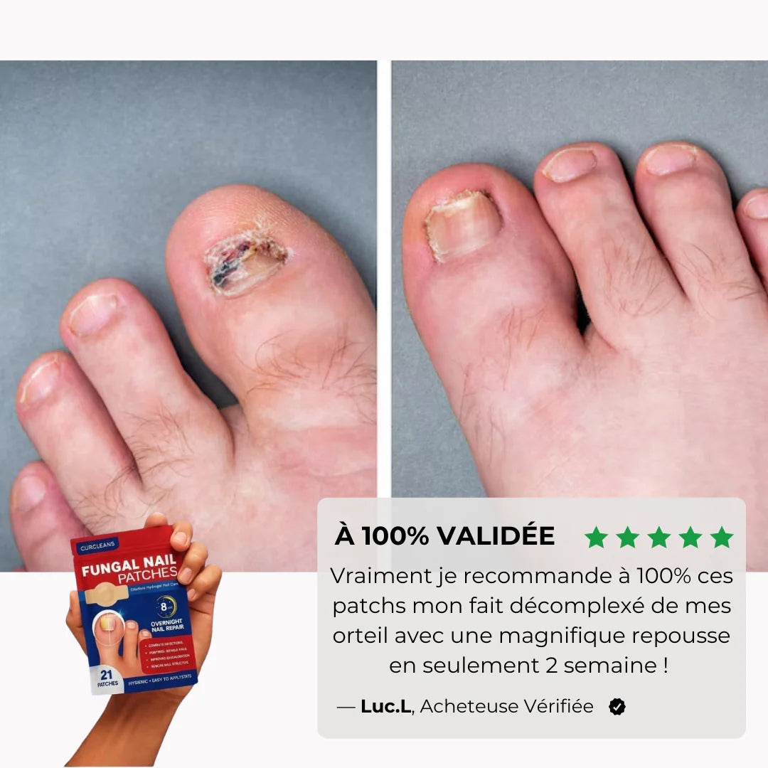 Pack 21 Patchs Antifongiques Pour Ongles Abîmés – Réparation Nocturne en 8H